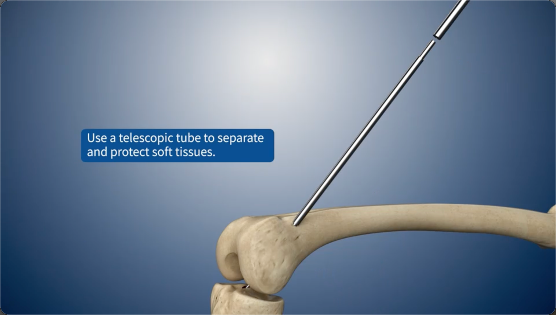 Use a telescopic tube to separate and protect soft tissues.