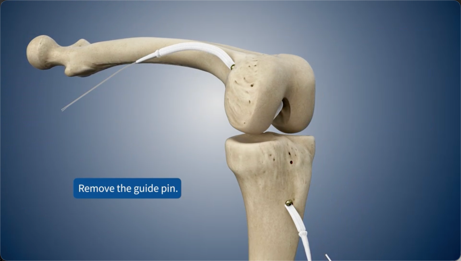 Remove the guide pin.