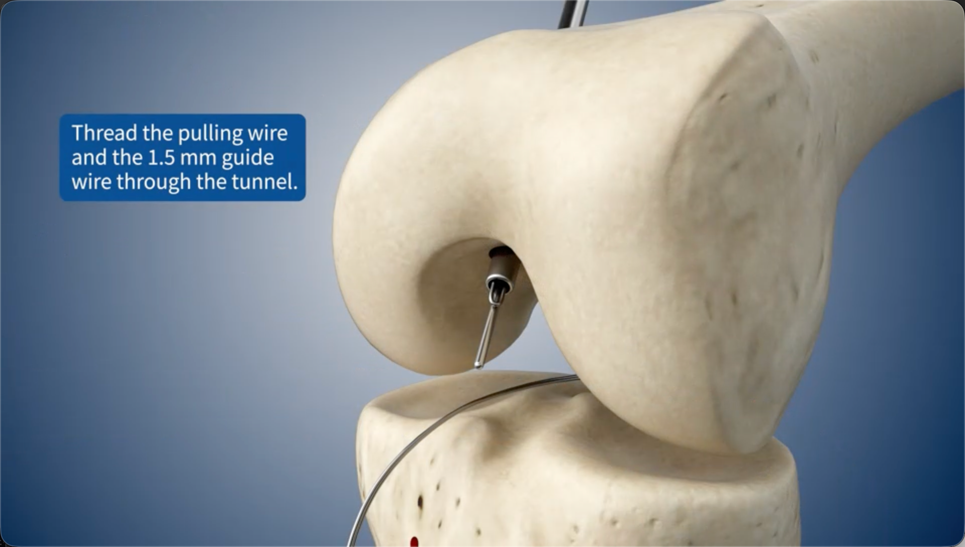 Thread the pulling wire and the 1.5 mm guide wire through the bone tunnel.