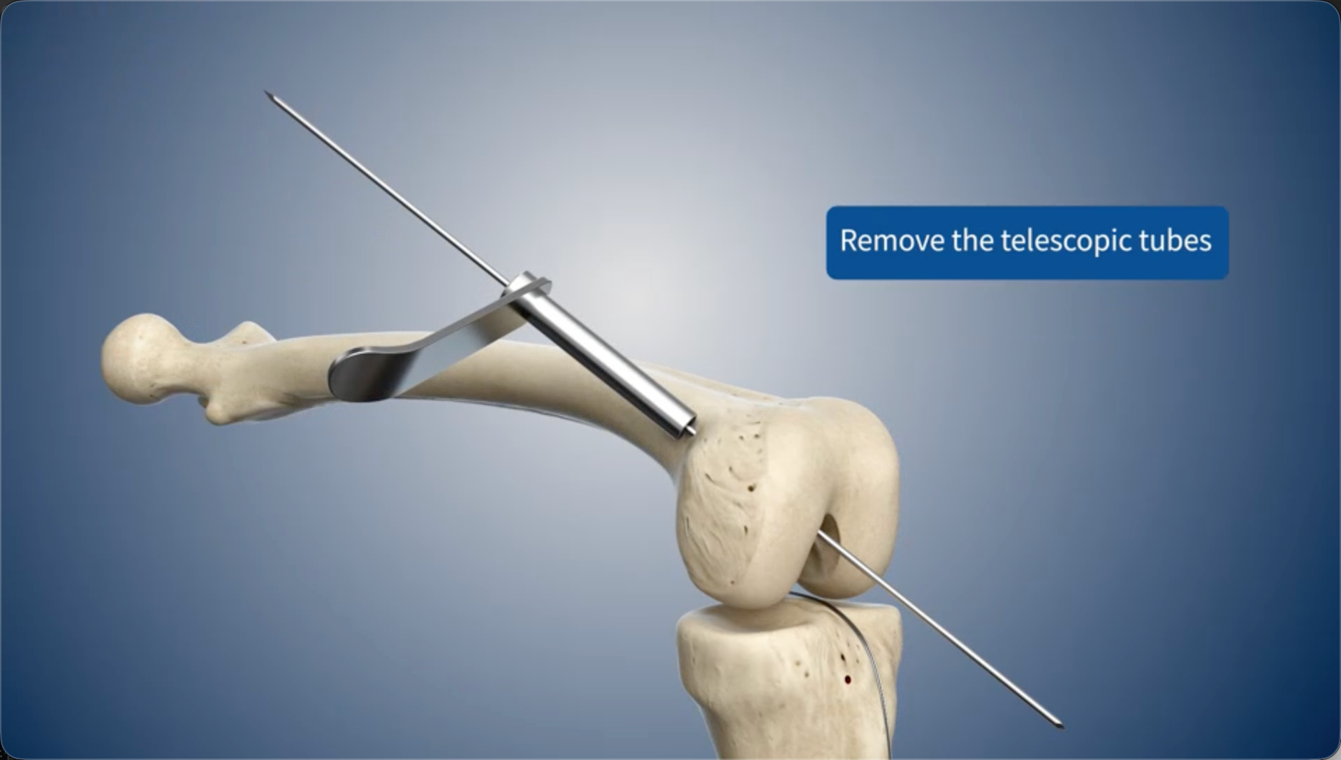 Remove the telescopic tubes
