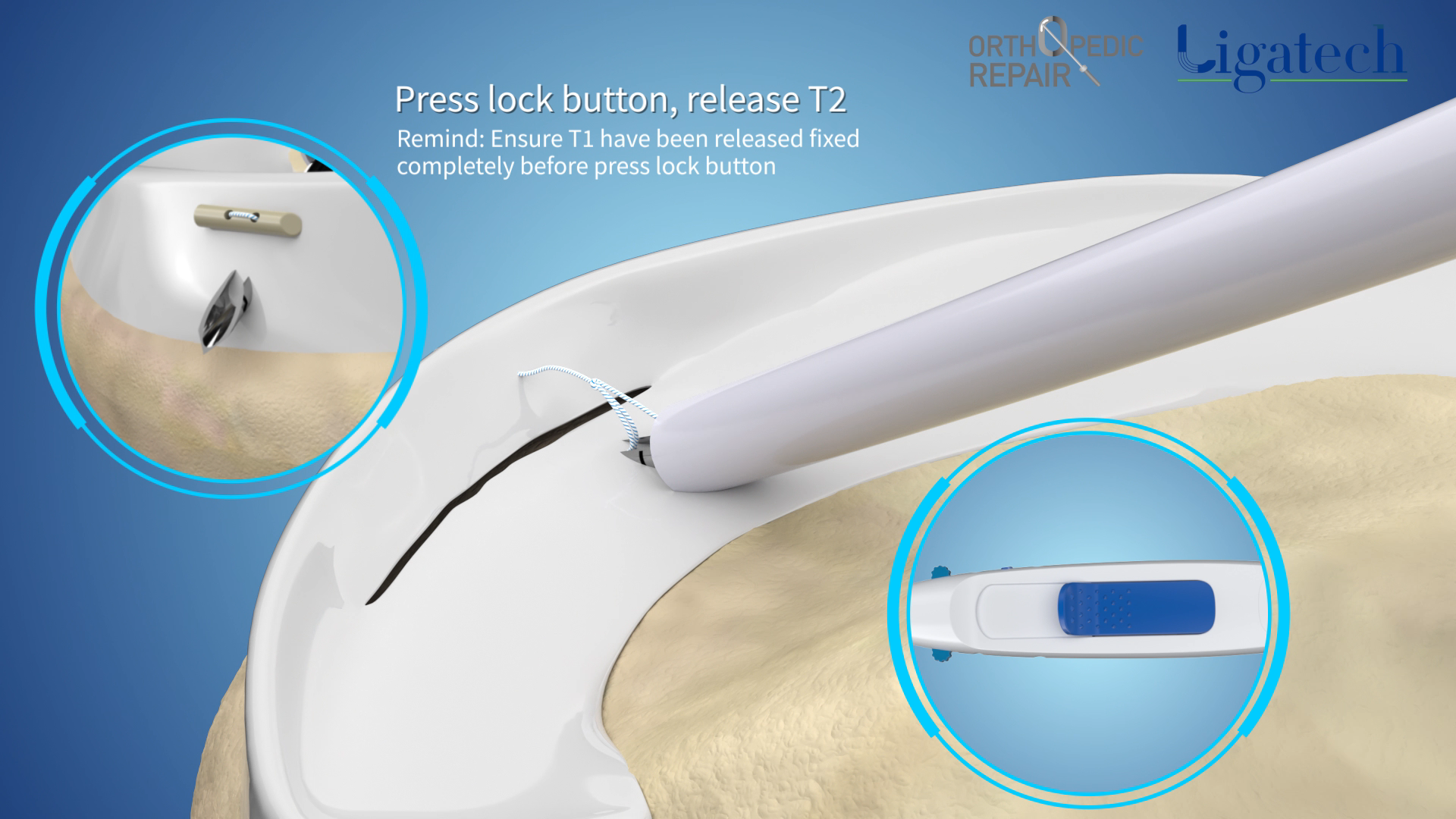 Press lock button, release T2Remind: Ensure T1 have been released fixed completely before press lock button