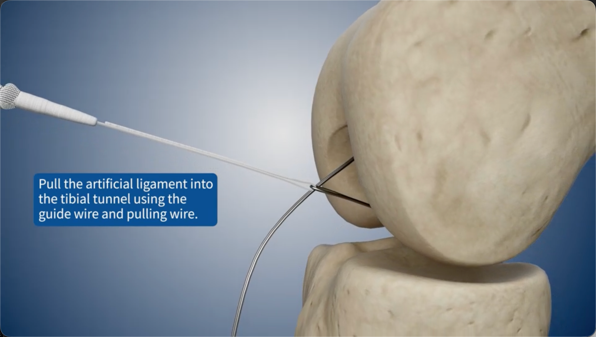 Pull the artificial ligament into the tibial bone tunnel using the guide wire and pulling wire.