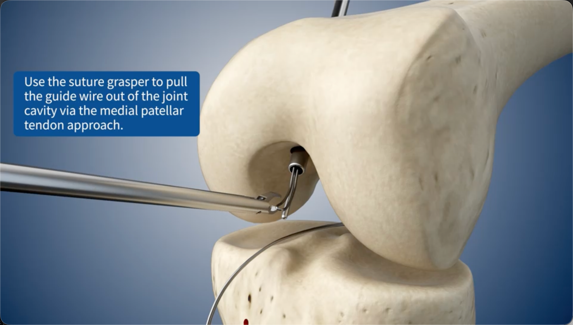Use the suture grasper to pull the guide wire out of the joint cavity via the medial patellar tendon approach.