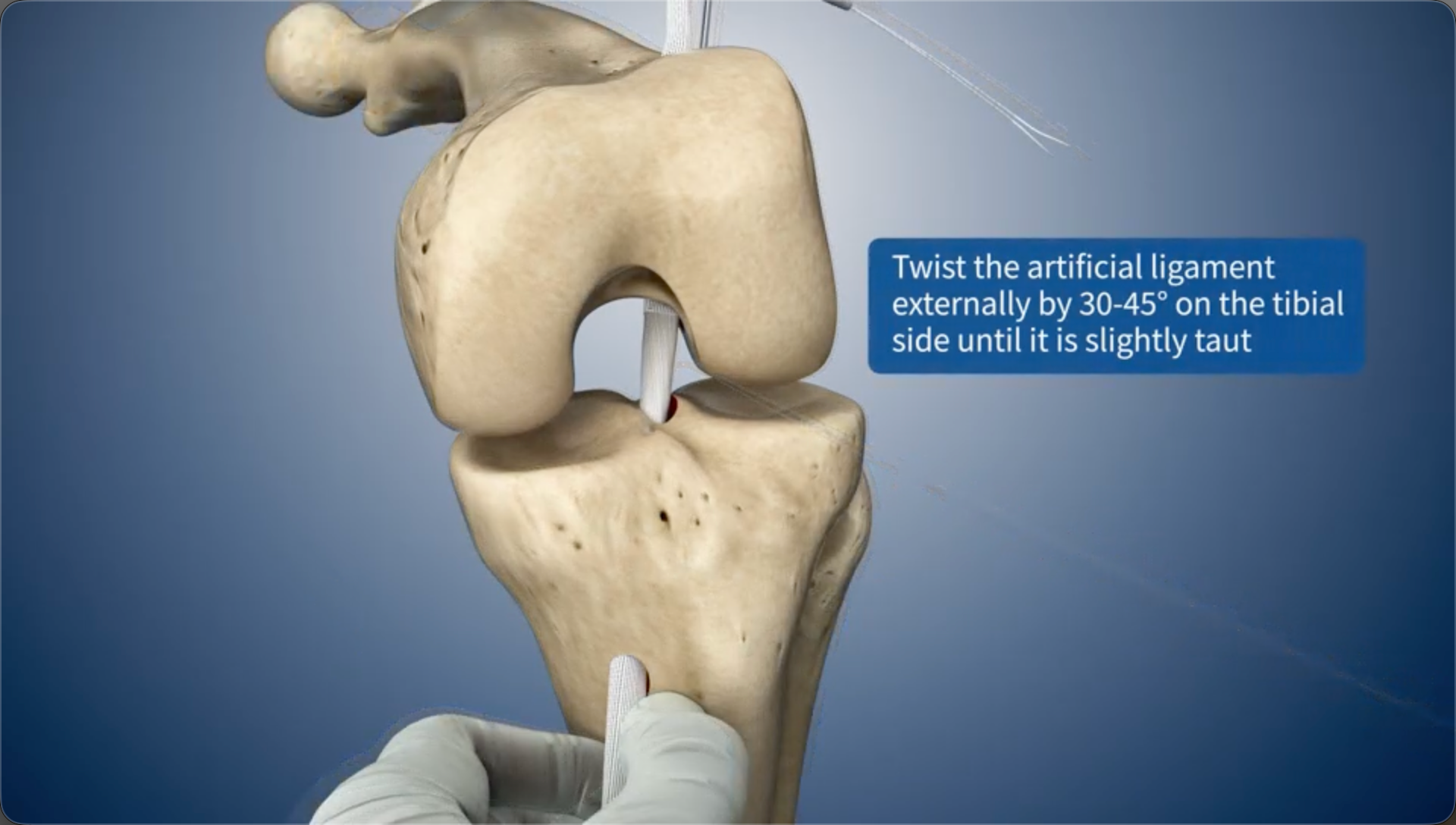 Twist the artificial ligament externally by 30-45° on the tibial side until it is slightly taut