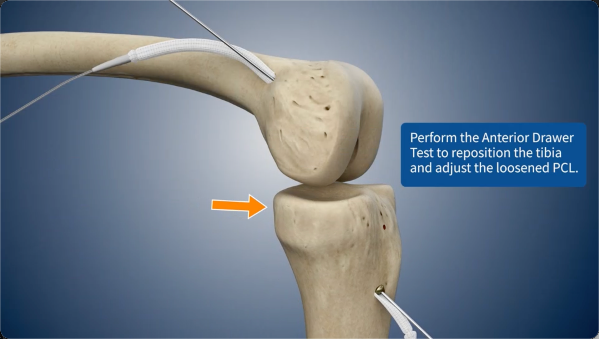 Perform the Anterior Drawer Test to reposition the tibia and adjust the loosened PCL.