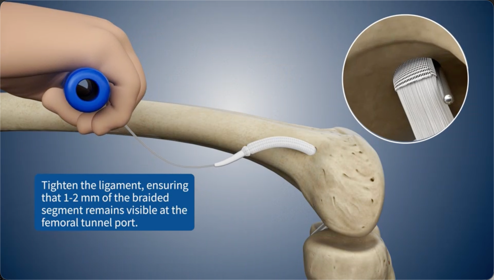 Tighten the ligament, ensuring that 1-2 mm of the braided segment remains visible at the femoral bone tunnel port.