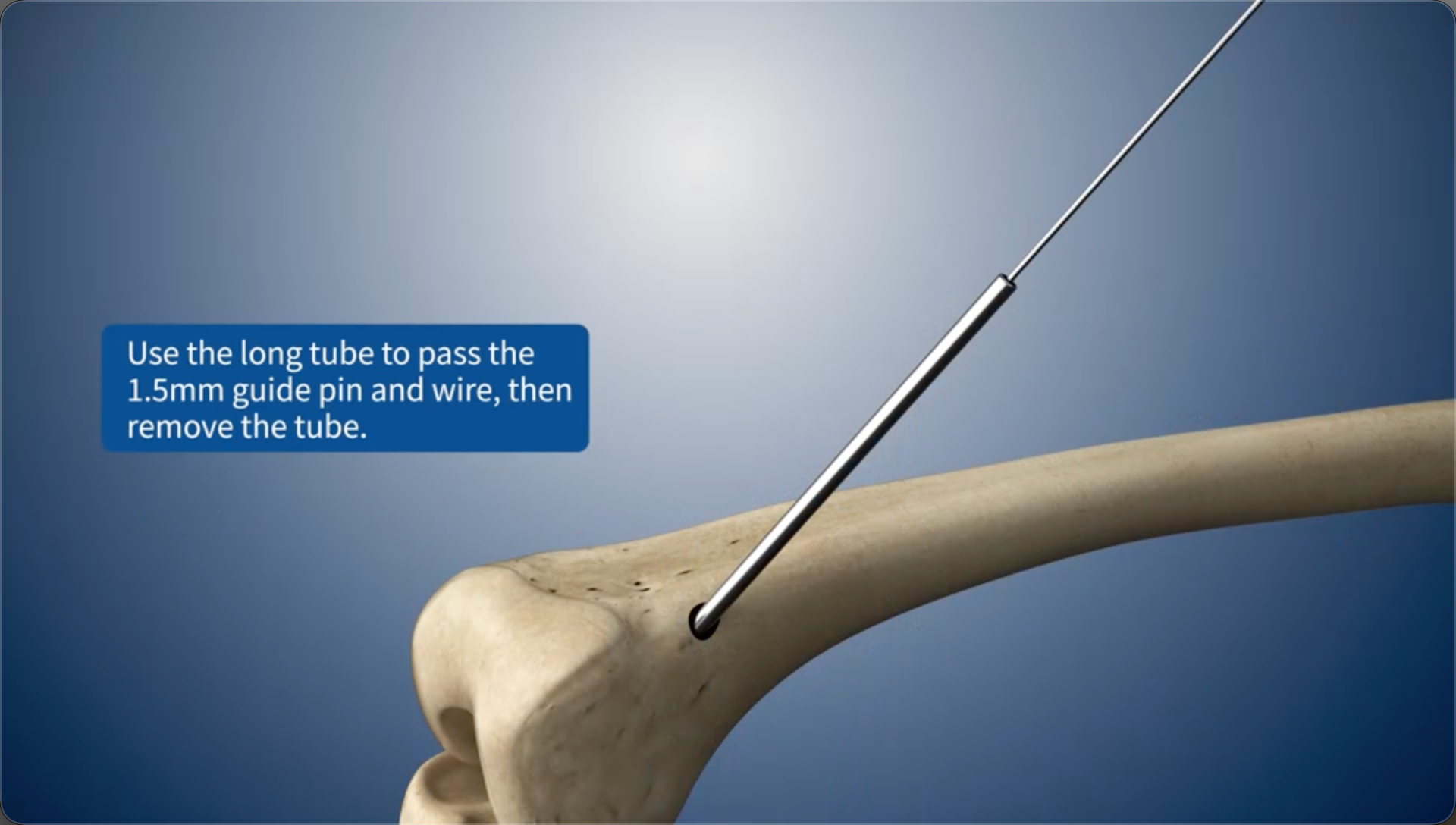 Use the long tube to pass the 1.5mm guide pin and wire, then remove the tube.