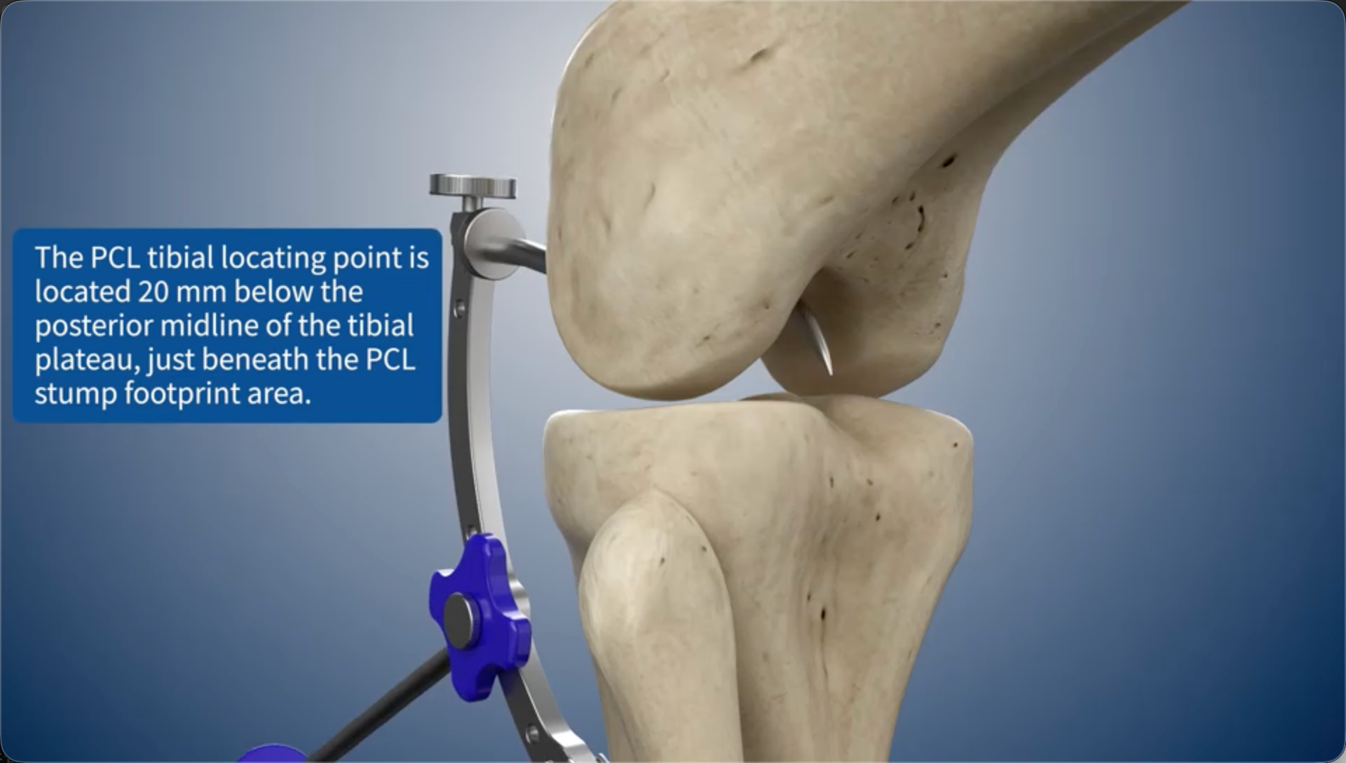 The PCL tibial locating point is located 20 mm below the posterior midline of the tibial plateau, just beneath the PCL stump footprint area.