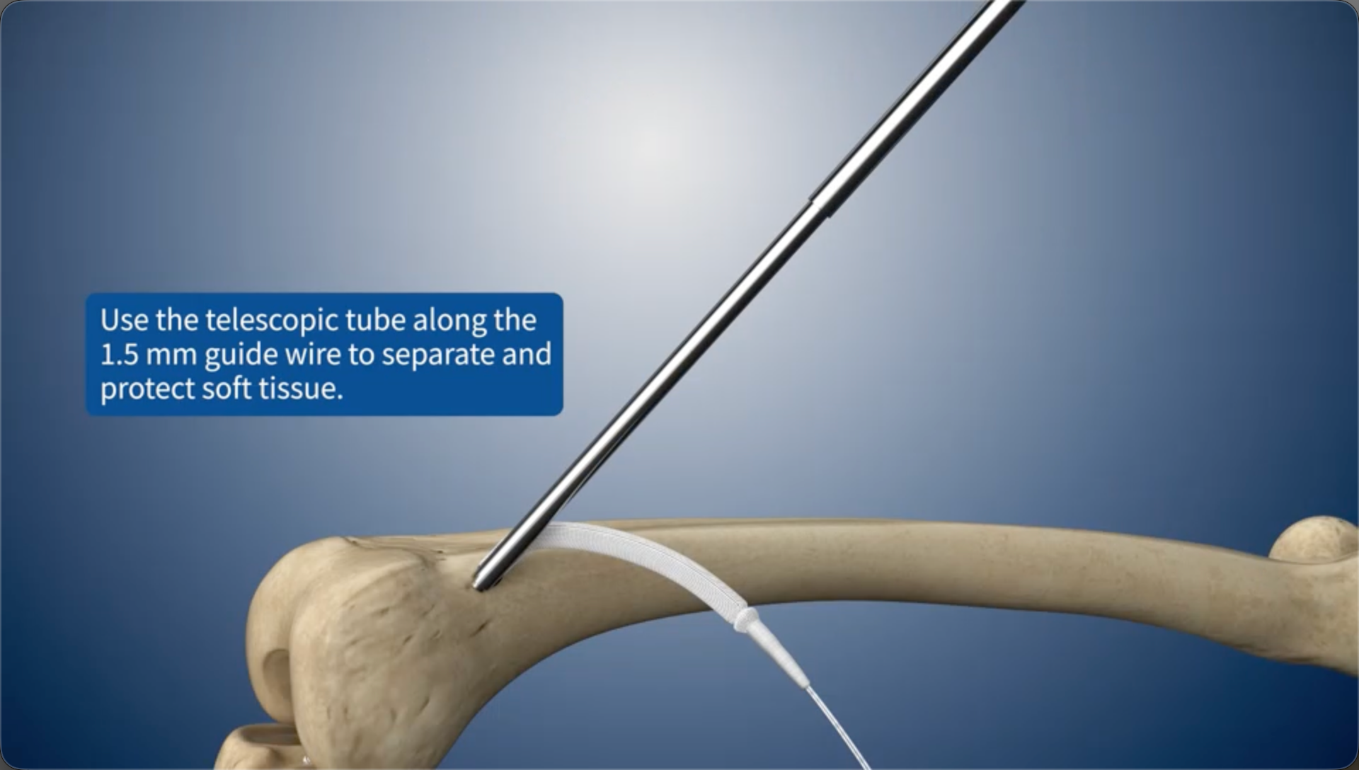 Use the telescopic tube along the 1.5 mm guide wire to separate and protect soft tissue.