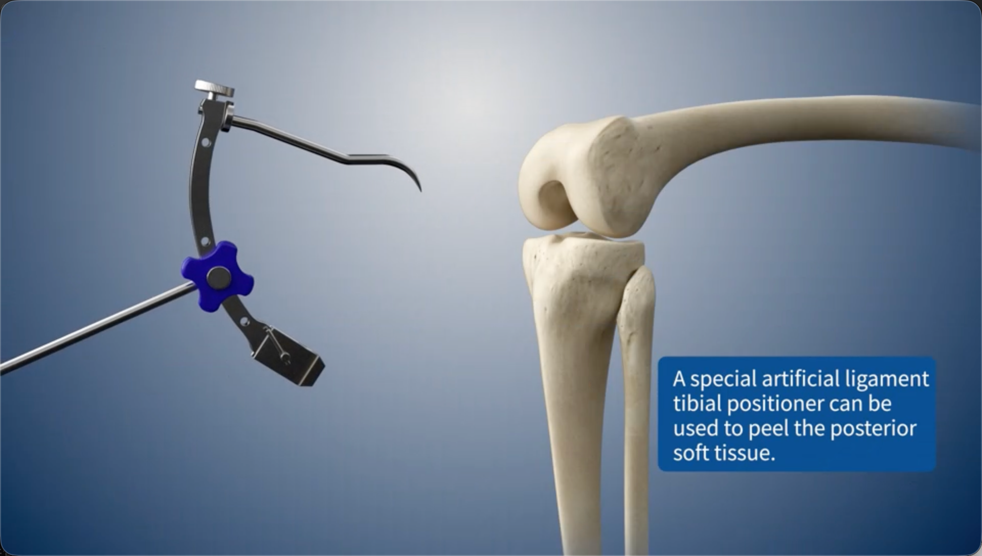 A special artificial ligament tibial positioner can be used to peel the posterior soft tissue.