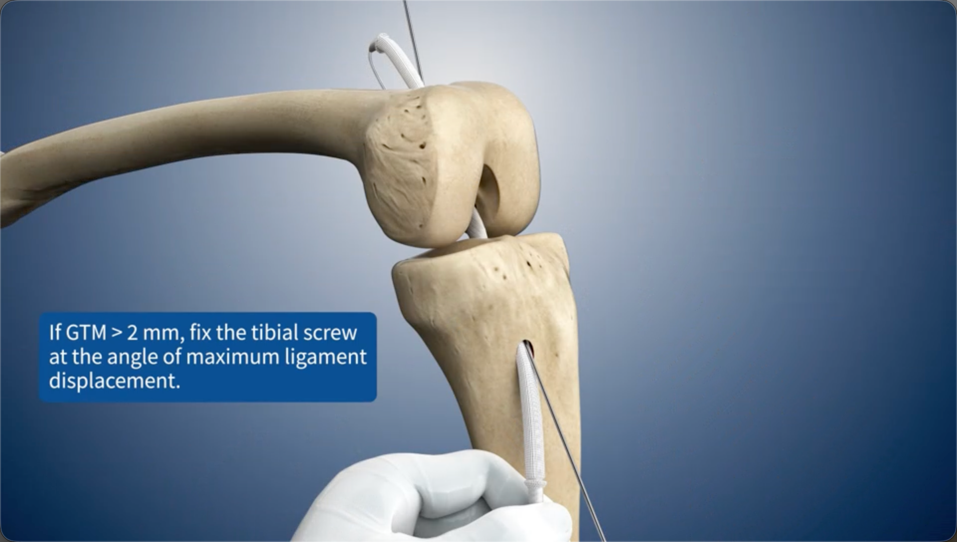 If GTM > 2 mm, fix the tibial screw at the angle of maximum ligament displacement.