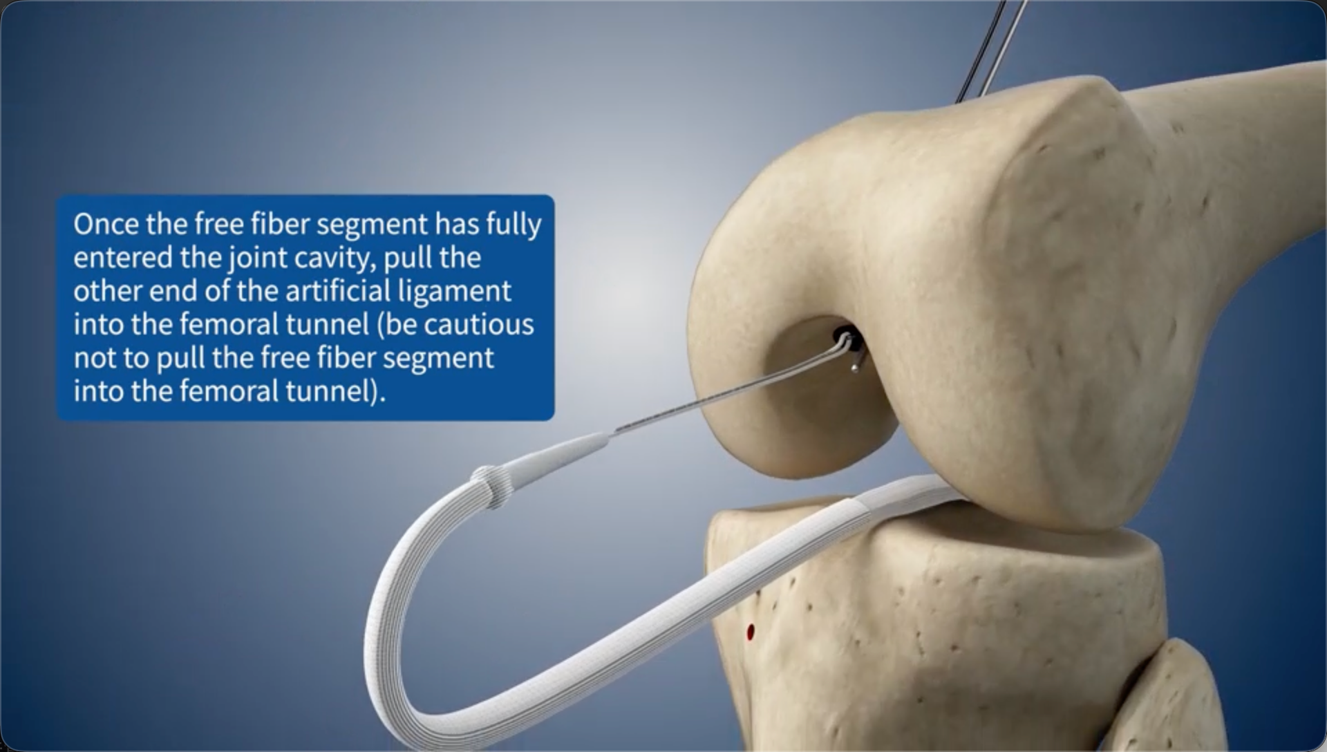 Once the free fiber segment has fully entered the joint cavity, pull the other end of the artificial ligament into the femoral bone tunnel (be cautious not to pull the free fiber segment into the femoral bone tunnel).