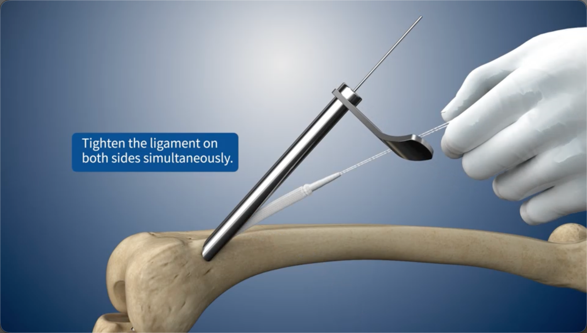 Tighten the ligament on both sides simultaneously.