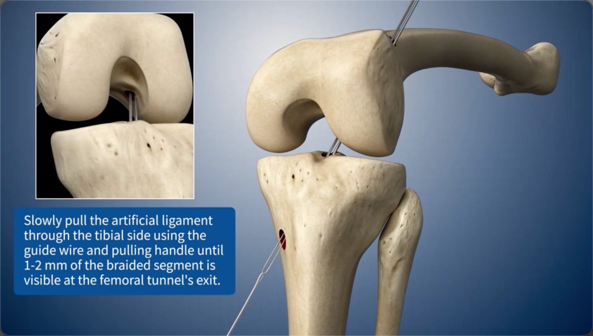 Slowly pull the artificial ligament through the tibial side using the guide wire and pulling handle until 1-2 mm of the braided segment is visible at the femoral bone tunnel's exit.