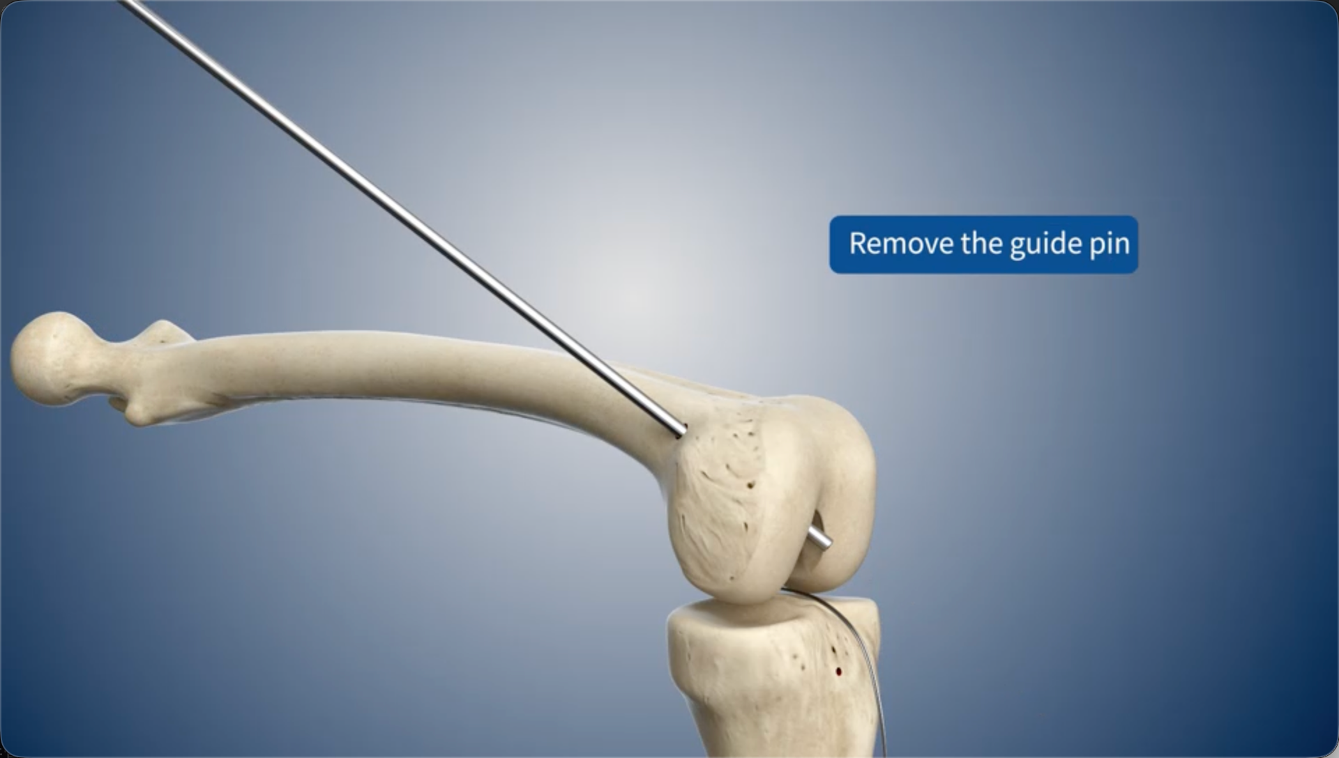 Remove the guide pin
